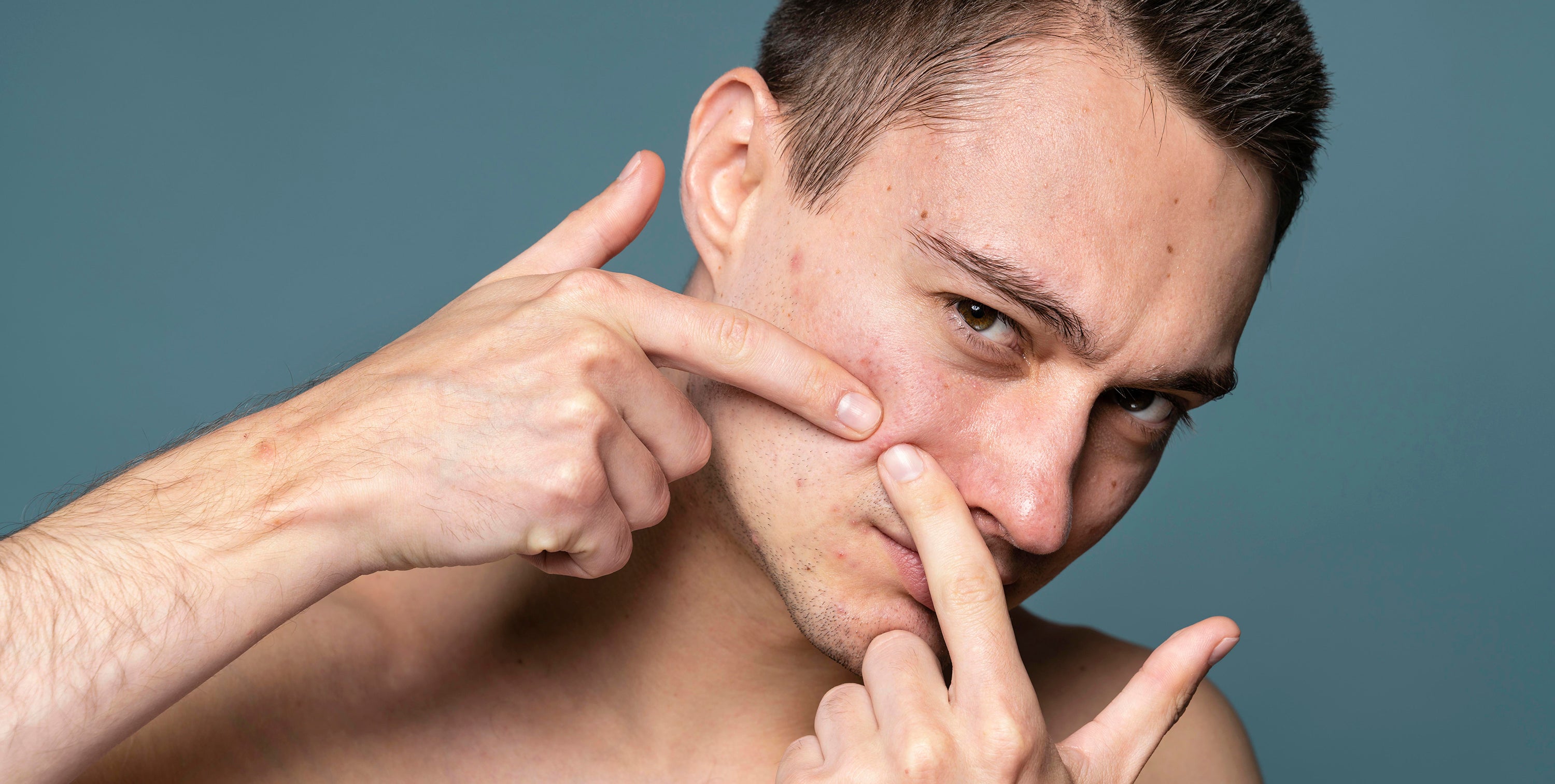 S.O.S ¡Me salió un grano!