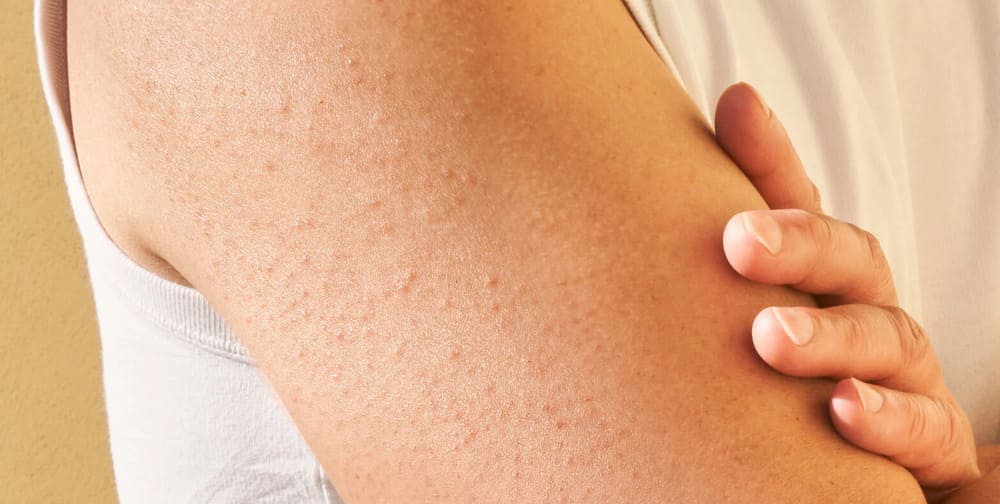 Queratosis Pilar: Qué es y cómo tratarla