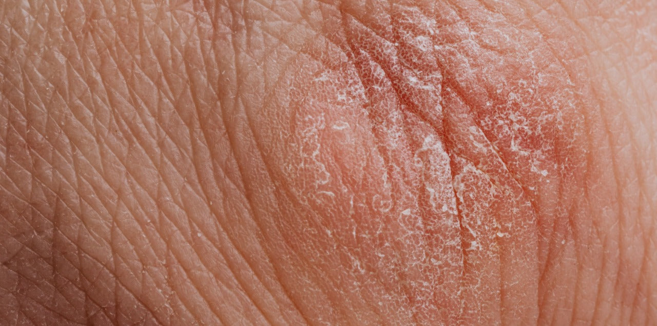 PSORIASIS, ¿QUÉ ES Y CÓMO SE TRATA?