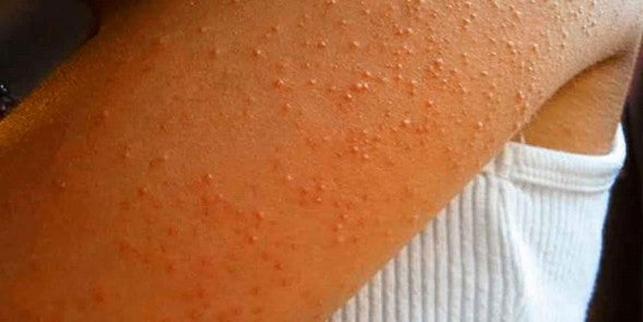 ¿CÓMO TRATAR LA QUERATOSIS PILAR?