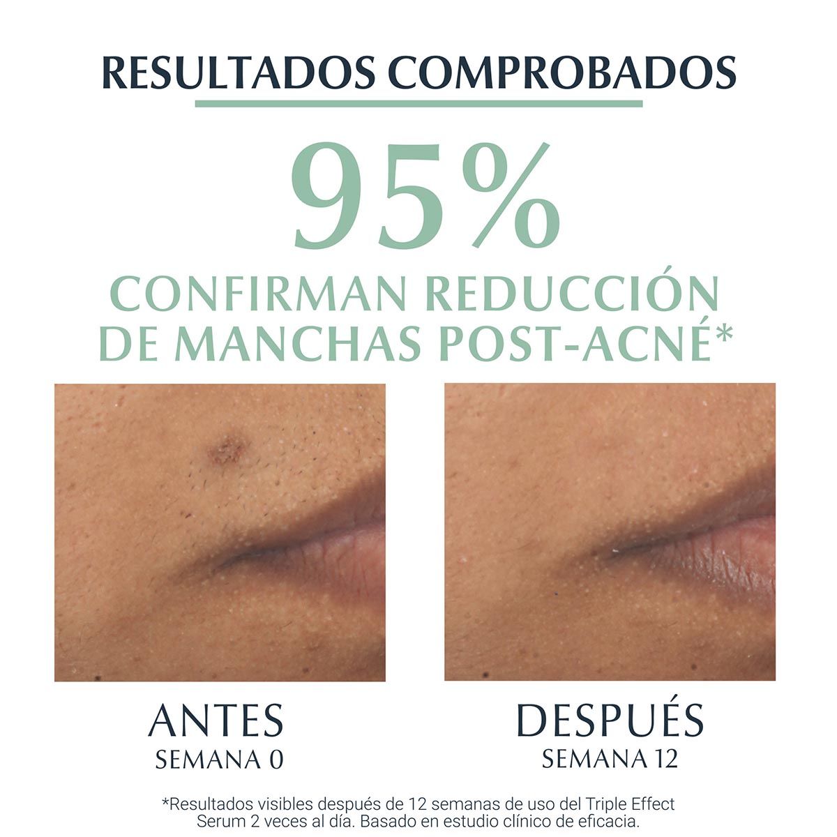 Eucerin Dermopure Triple Effect Sérum anti-imperfecciones para piel grasa y con tendencia acneica 40 ml