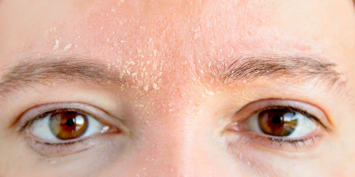 Escamas Rojas ¿DESCAMACIÓN Y ZONAS ROJAS? PUEDE SER DERMATITIS SEBORREICA – Dermaexpress