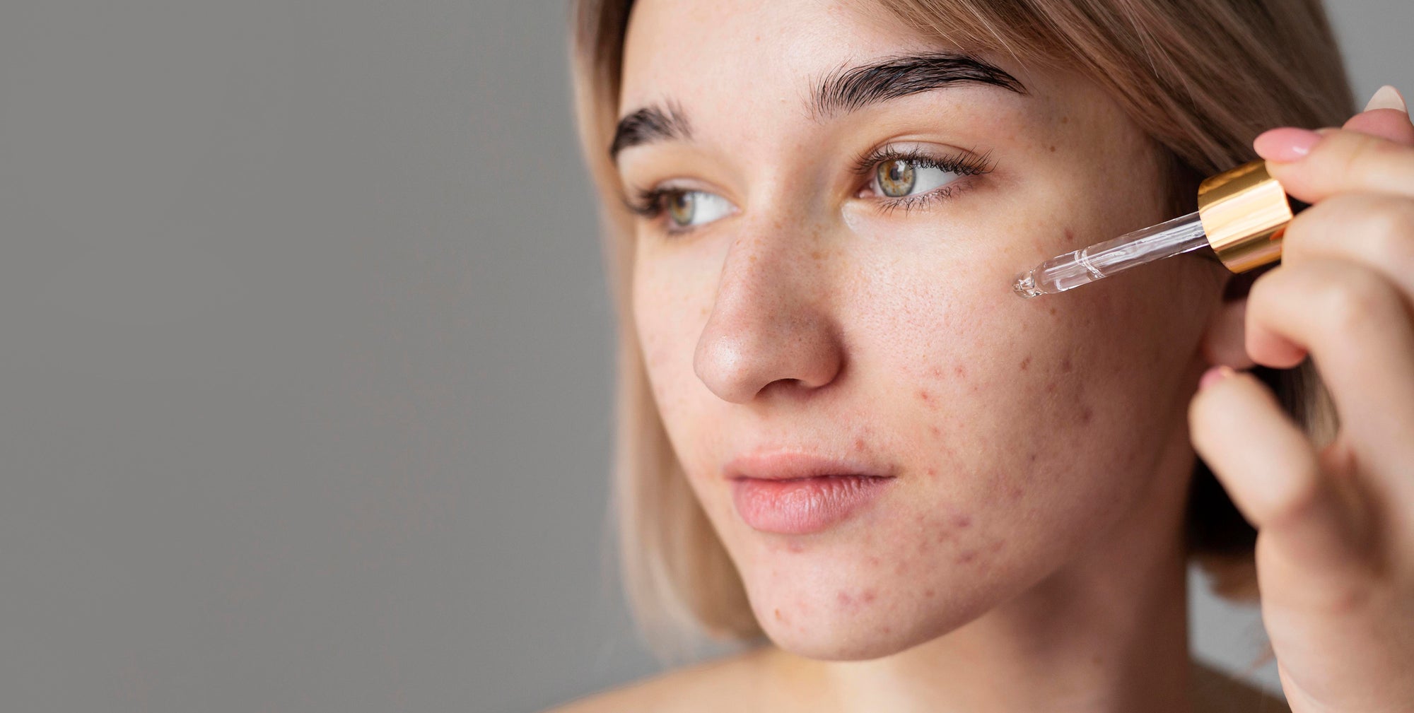 Activos para tratar el Acné