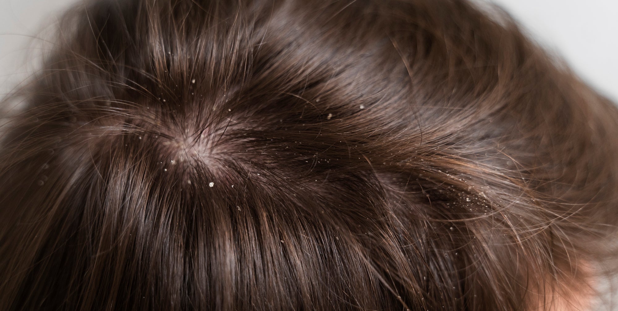 ¿Todos tenemos caspa?