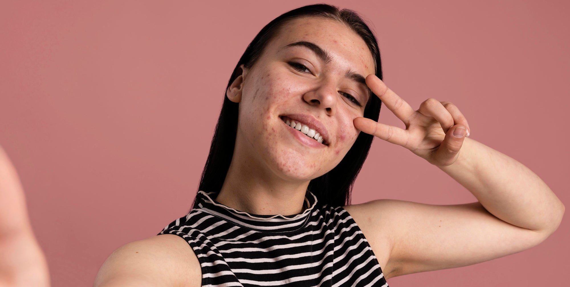 Tipos de Acné y cómo identificarlos.