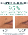 Eucerin Dermopure triple effect serum para piel grasa y/o con tendencia acneica 40ml.